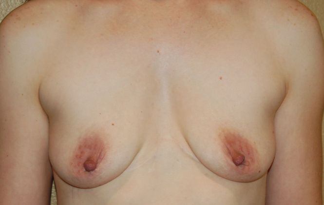Breast Augmentation w/ Lift: Case 198 - Before
