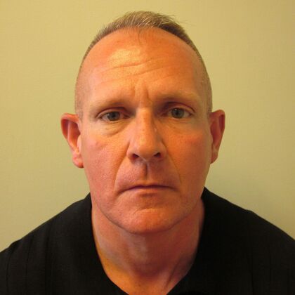 Otoplasty Case 4 - Otoplasty, Norwalk - Before