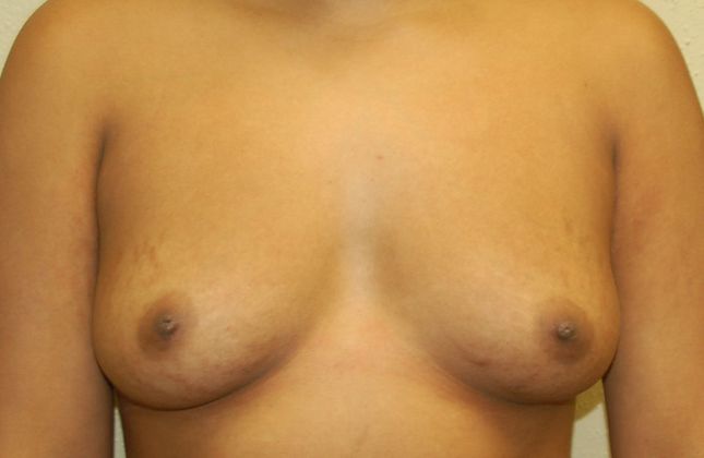 Breast Augmentation Case 423 - Before