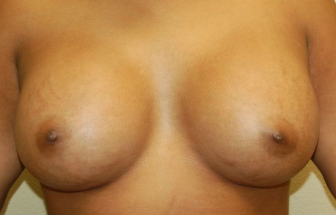 Breast Augmentation Case 423 - After