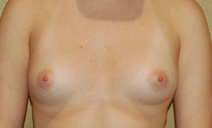 Breast Augmentation Case 424 - Before