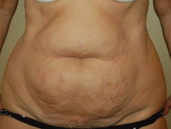 Tummy Tuck (Abdominoplasty) Case 118 - Before