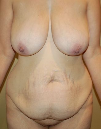 Mommy Makeover Case 84 - Before