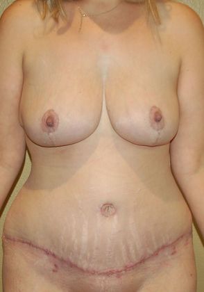 Massive Weight Loss : Case 41 - After