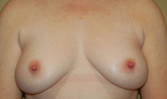 Breast Reconstruction Case 56 - Before
