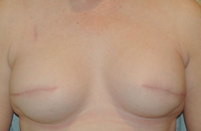 Breast Reconstruction Case 56 - After