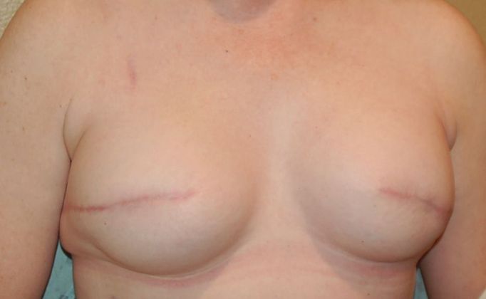 Breast Reconstruction: Case 56 - After