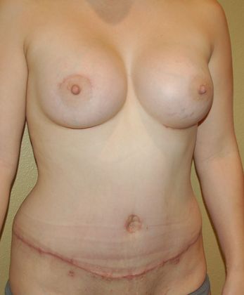 Mommy Makeover: Case 86 - After