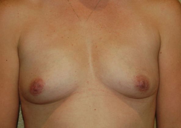 Breast Augmentation w/ Lift Case 201 - Before