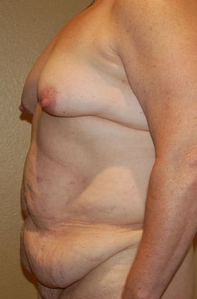 Mommy Makeover: Case 88 - Before