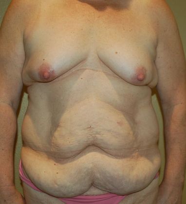 Massive Weight Loss : Case 42 - Before