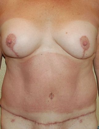 Massive Weight Loss : Case 42 - After