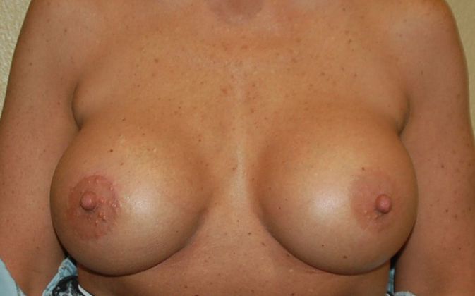 Breast Revision: Case 77 - After
