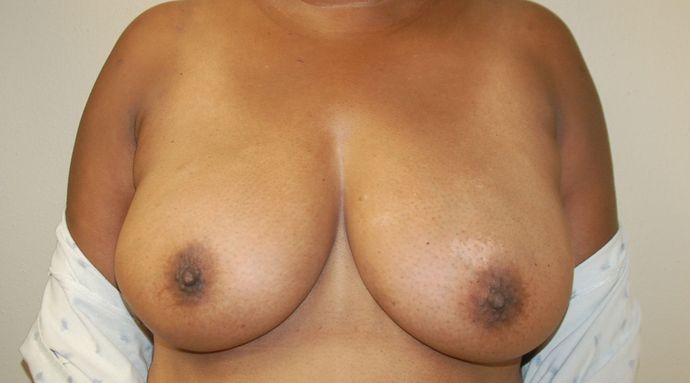 Breast Lift (Mastopexy) Case 52 - Before