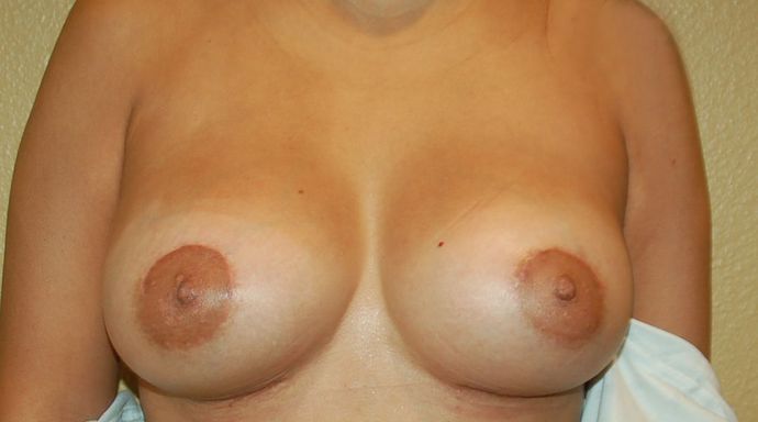 Breast Augmentation Case 429 - After