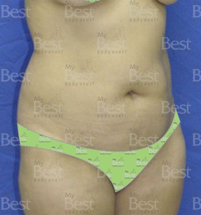 Tummy Tuck: Mommy Makeover after five years - Before Abdominoplasty oblique