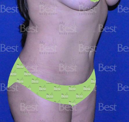 Tummy Tuck: Mommy Makeover after five years - After abdominoplasty oblique