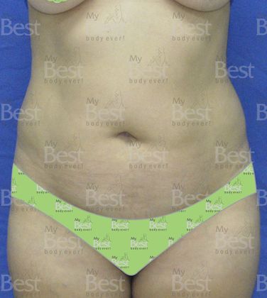 Tummy Tuck: Mommy Makeover after five years - Before Abdominoplasty Frontal
