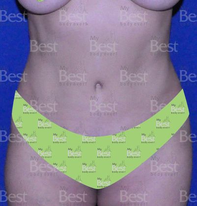 Tummy Tuck: Mommy Makeover after five years - after abdominoplasty frontal