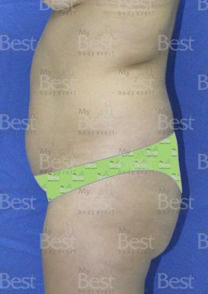 Tummy Tuck: Mommy Makeover after five years - before Abdominoplasty lateral