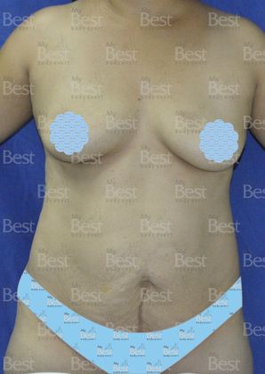 Mommy Makeover -Abdomen, Breast, Lipo, BBL- Abdominoplasty and Breast Augmentation - Before
