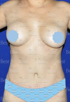 Mommy Makeover -Abdomen, Breast, Lipo, BBL- Abdominoplasty and Breast Augmentation - After