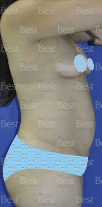 Mommy Makeover -Abdomen, Breast, Lipo, BBL-: Abdominoplasty and Breast Augmentation - Before Mommy Makeover Lateral view