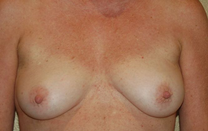 Breast Augmentation w/ Lift: Case 206 - Before