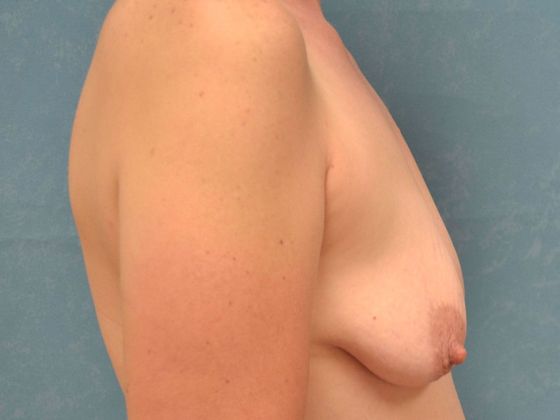 Breast Augmentation: BA1357 - Perrysburg, OH - Before