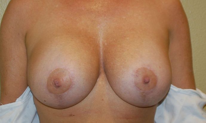 Breast Augmentation w/ Lift Case 207 - After