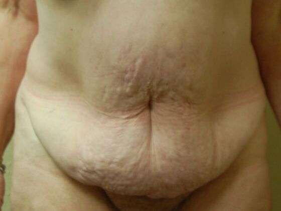 Tummy Tuck (Abdominoplasty) Case 123 - Before