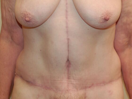 Tummy Tuck (Abdominoplasty) Case 123 - After