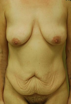 Mommy Makeover Case 89 - Before