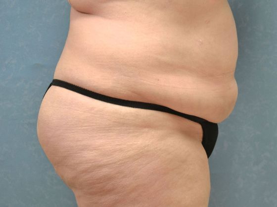 Bodylift C1212 - Oregon, OH - Before