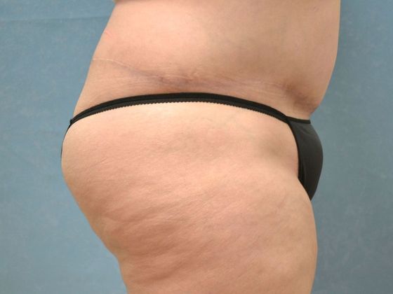 Bodylift C1212 - Oregon, OH - After