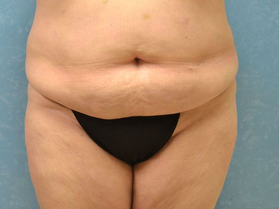 Bodylift C1220 - Oregon, OH - Before