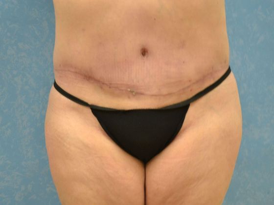 Bodylift C1220 - Oregon, OH - After