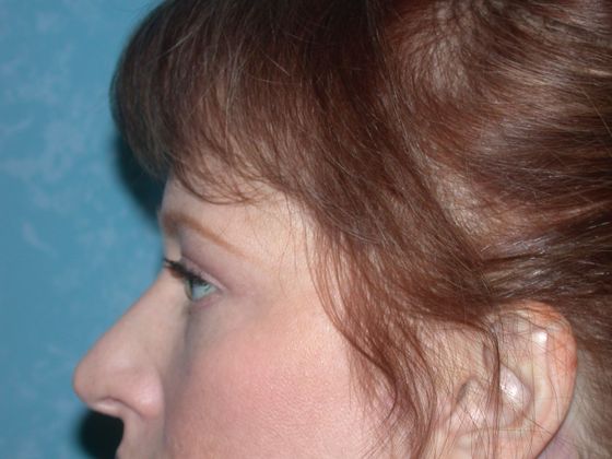 Eye Lift (Blepharoplasty): ULB1404 - Oregon, OH - After