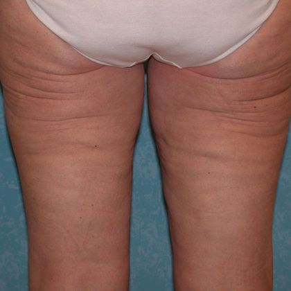 Thigh Lift: TL1403 - Bowling Green, OH - Before