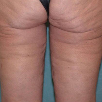 Thigh Lift: TL1403 - Bowling Green, OH - After