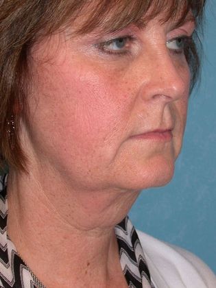 Face & Neck Lifts FL1336 - Defiance, OH - Before