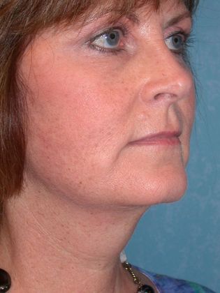 Face & Neck Lifts FL1336 - Defiance, OH - After