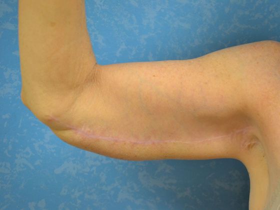 Arm Lift BY1203 - Maumee, OH - After