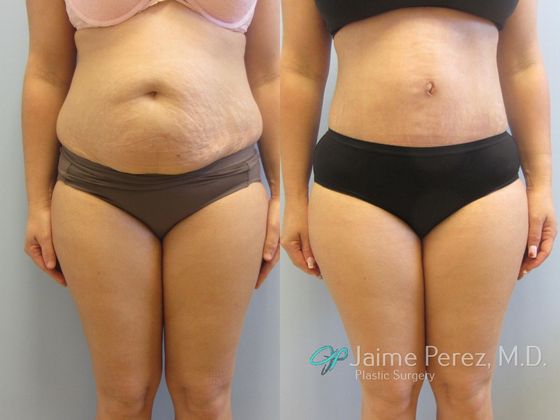 Lipoabdominoplasty with Muscle Repair - Abdominoplasty/Tummy Tuck - Before  and After Gallery