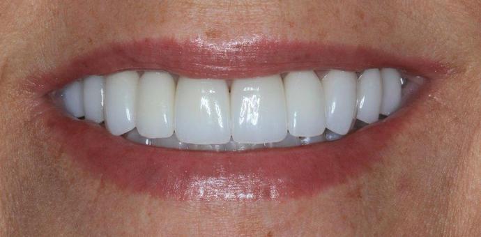 Porcelain Veneers: Case 23 - after
