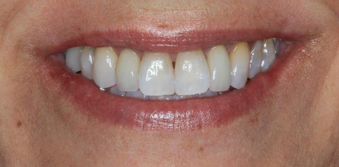 Porcelain Veneers: Case 23 - before