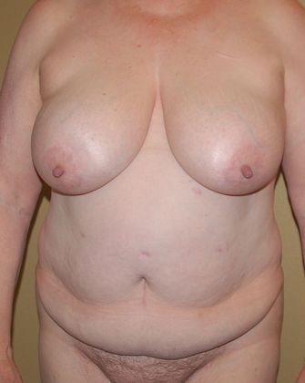 Mommy Makeover Case 91 - Before