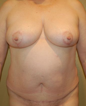 Mommy Makeover Case 91 - After