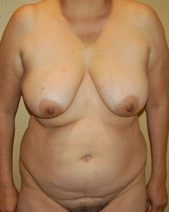 Mommy Makeover Case 92 - Before