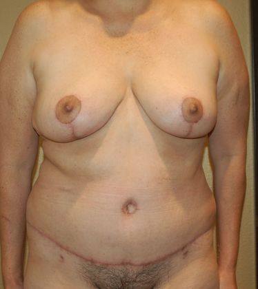 Mommy Makeover Case 92 - After